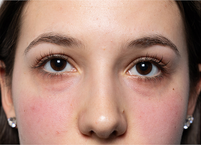 Nekirurško uklanjanje podočnjaka - prije 3