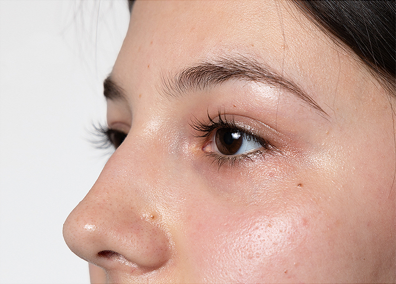 Nekirurško uklanjanje podočnjaka - poslije 4