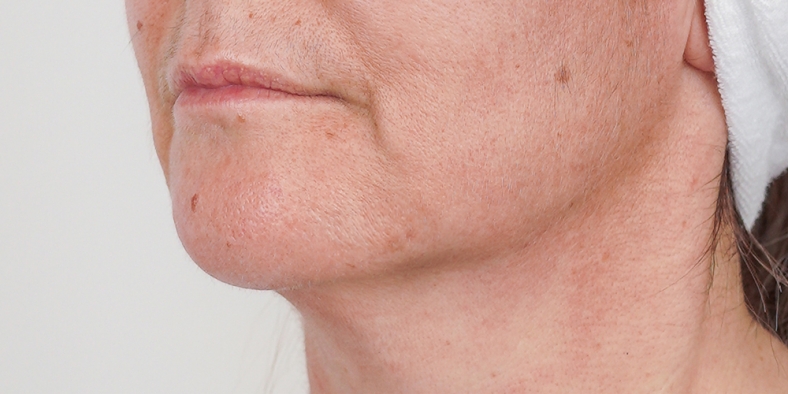 Oblikovanje brade i vilice - 1 - poslije