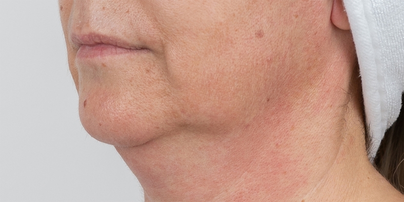 Oblikovanje brade i vilice - 1 - prije 