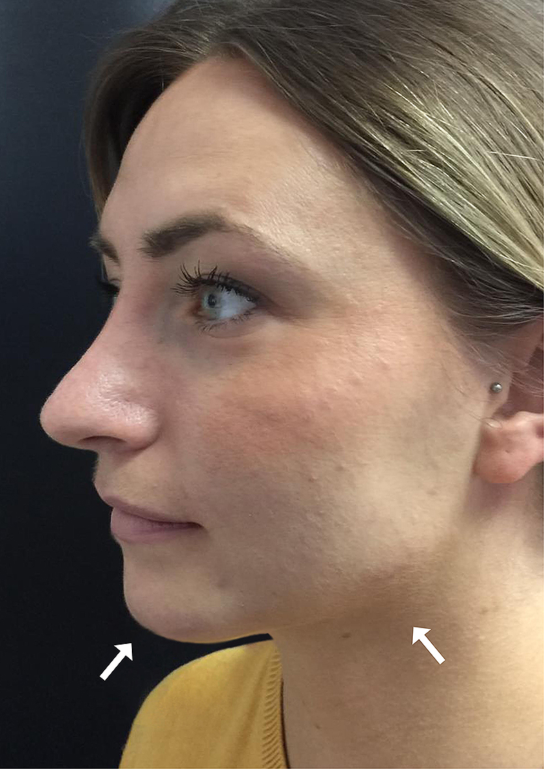 Oblikovanje brade i vilice Volux filerom, poslije