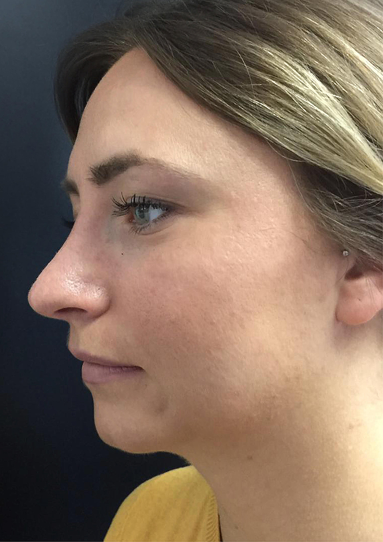 Oblikovanje brade i vilice Volux filerom, prije