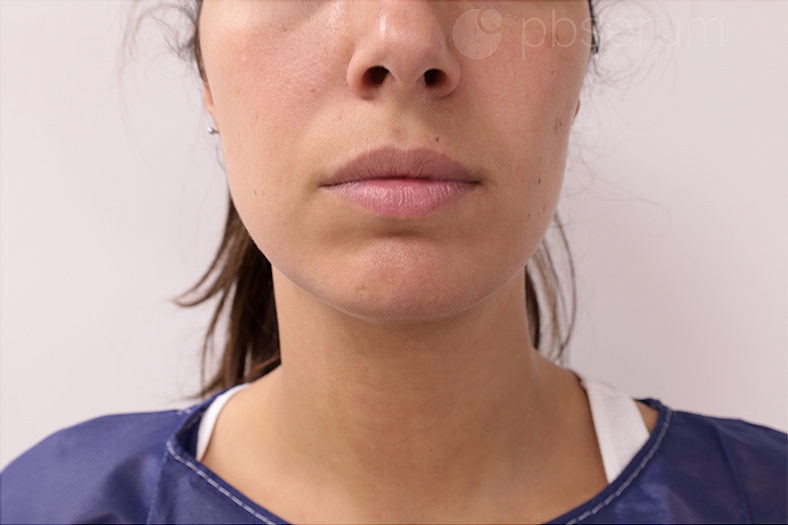 PB Serum, podbradak, sl. 1 - poslije