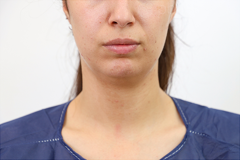 PB Serum, podbradak, sl. 1 - prije