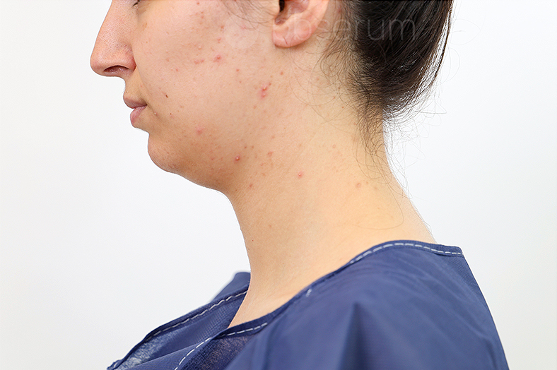 PB Serum, podbradak, sl. 2 - prije