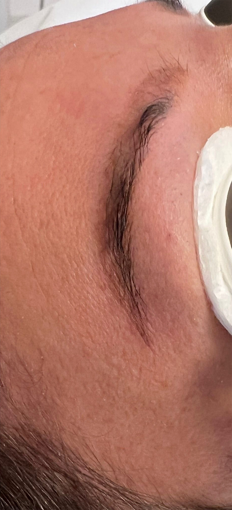 PiQo4 za uklanjanje neželjenih tetovaža, sl. 3 - poslije