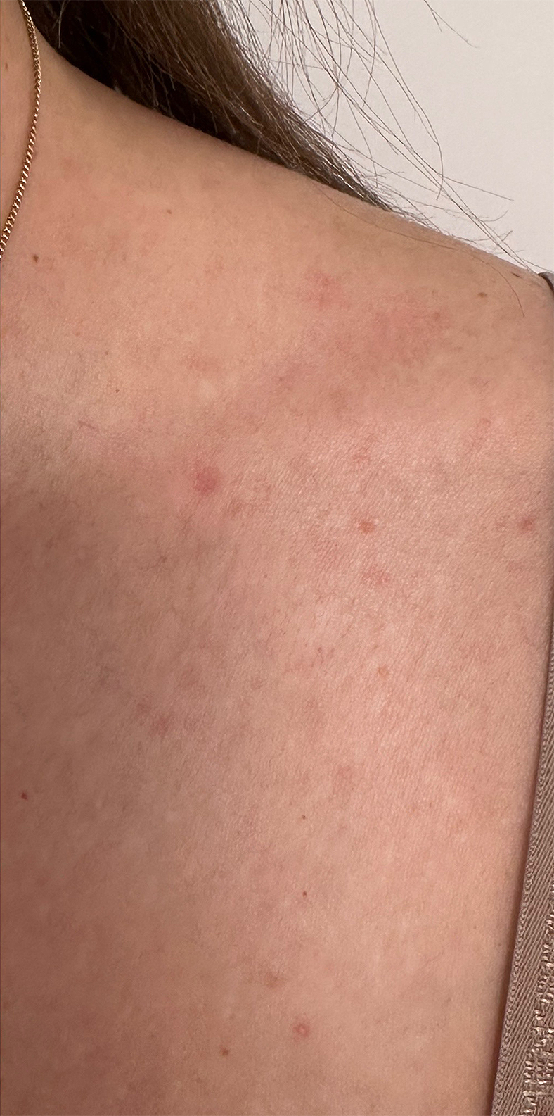 PiQo4 za uklanjanje neželjenih tetovaža, sl. 4 - poslije