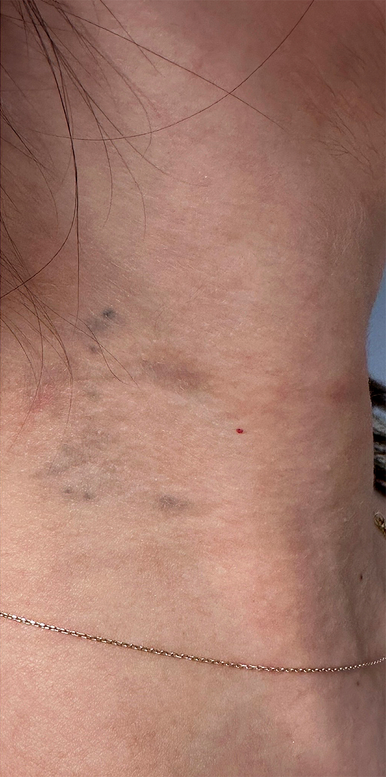 PiQo4 za uklanjanje neželjenih tetovaža, sl. 5 - poslije