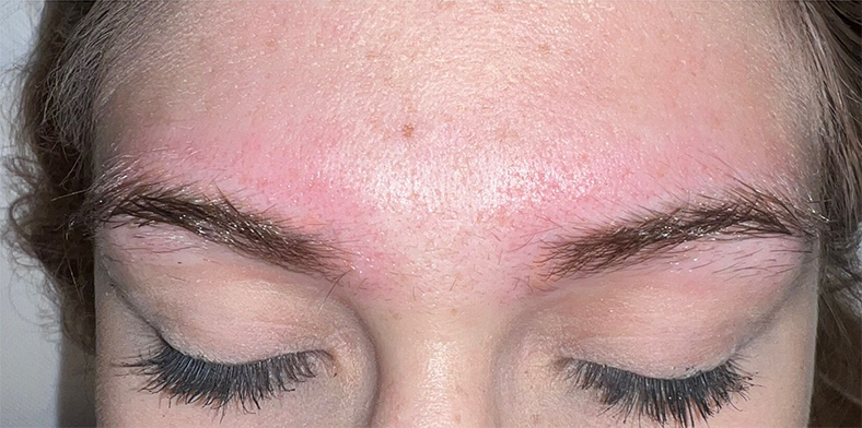 PiQo4 za uklanjanje neželjenih tetovaža, sl. 6 - poslije