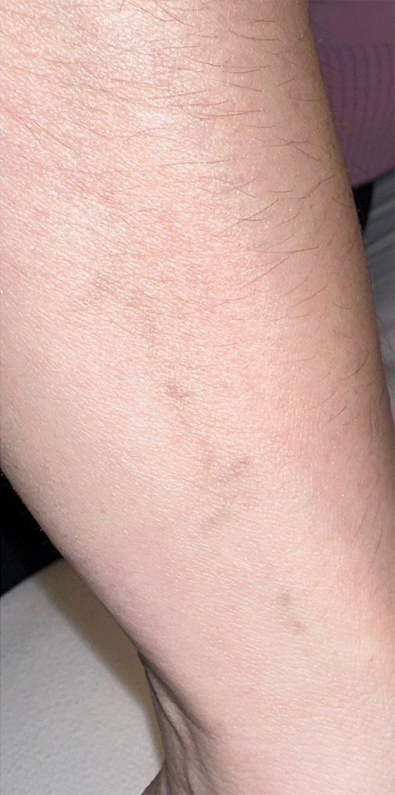 PiQo4 za uklanjanje neželjenih tetovaža, sl. 7 - poslije