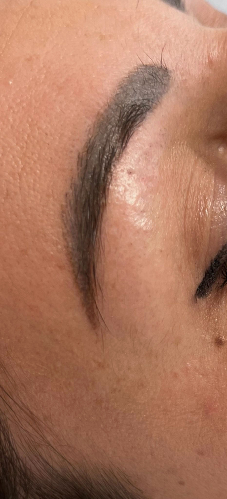 PiQo4 za uklanjanje neželjenih tetovaža, sl. 3 - prije