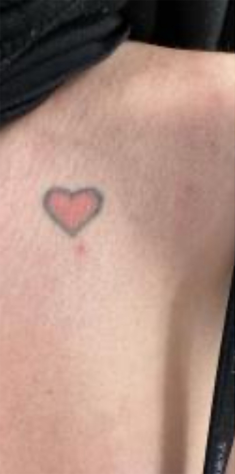 PiQo4 za uklanjanje neželjenih tetovaža, sl. 4 - prije