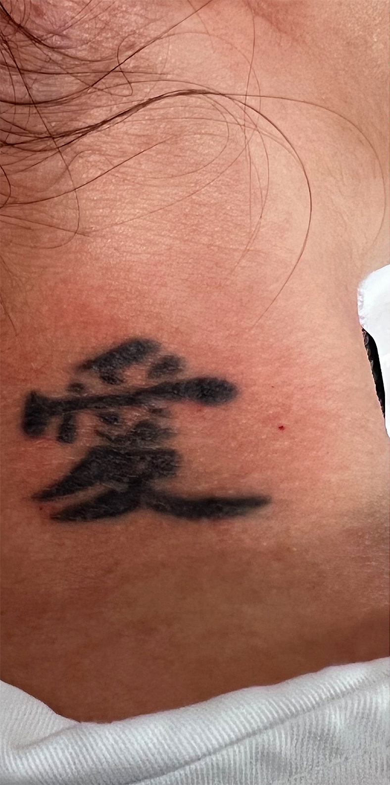 PiQo4 za uklanjanje neželjenih tetovaža, sl. 5 - prije