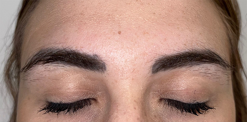 PiQo4 za uklanjanje neželjenih tetovaža, sl. 6 - prije