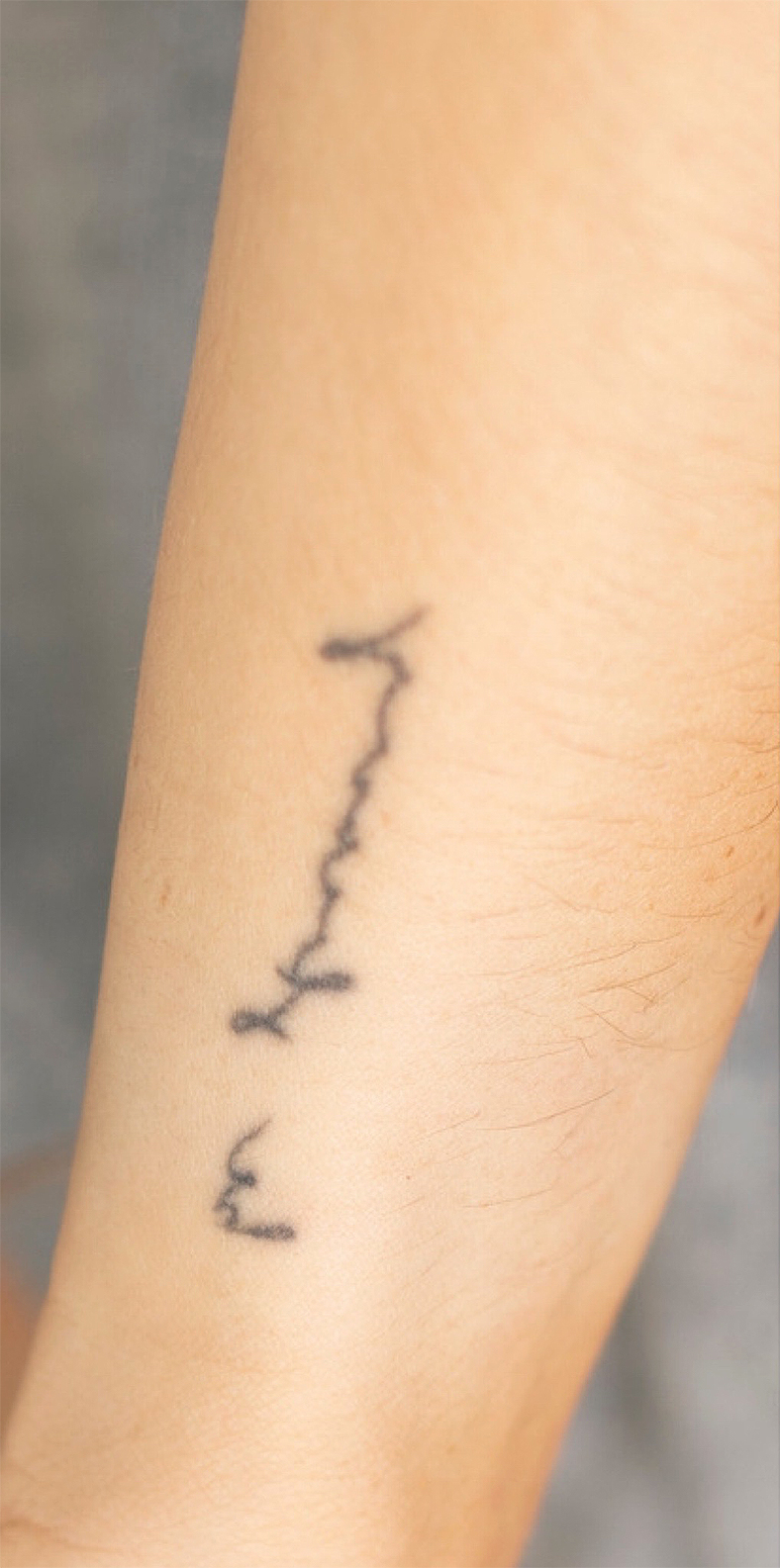 PiQo4 za uklanjanje neželjenih tetovaža, sl. 7 - prije