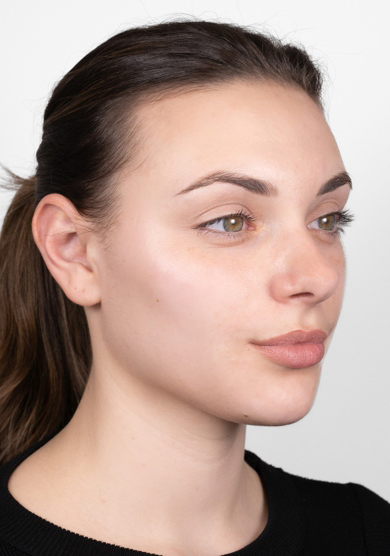 Oblikovanje brade i vilice dermalnim filerom, 2023. sl. 1 - poslije