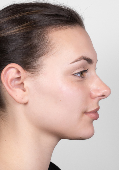 Oblikovanje brade i vilice dermalnim filerom, 2023. sl. 2 - poslije