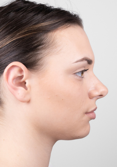 Oblikovanje brade i vilice dermalnim filerom, 2023. sl. 2 - prije