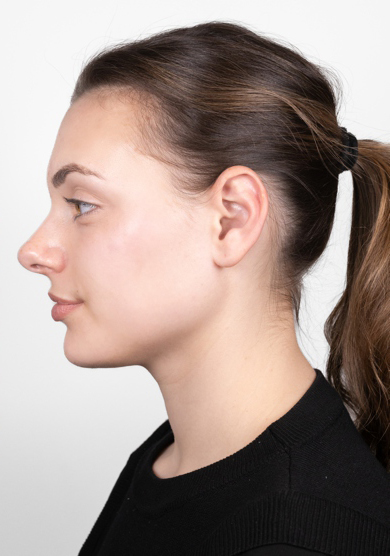 Oblikovanje brade i vilice dermalnim filerom, 2023. sl. 4 - poslije