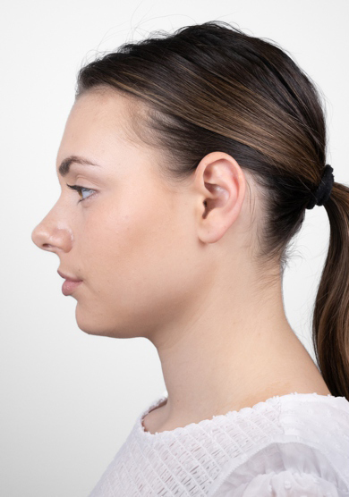 Oblikovanje brade i vilice dermalnim filerom, 2023. sl. 4 - prije