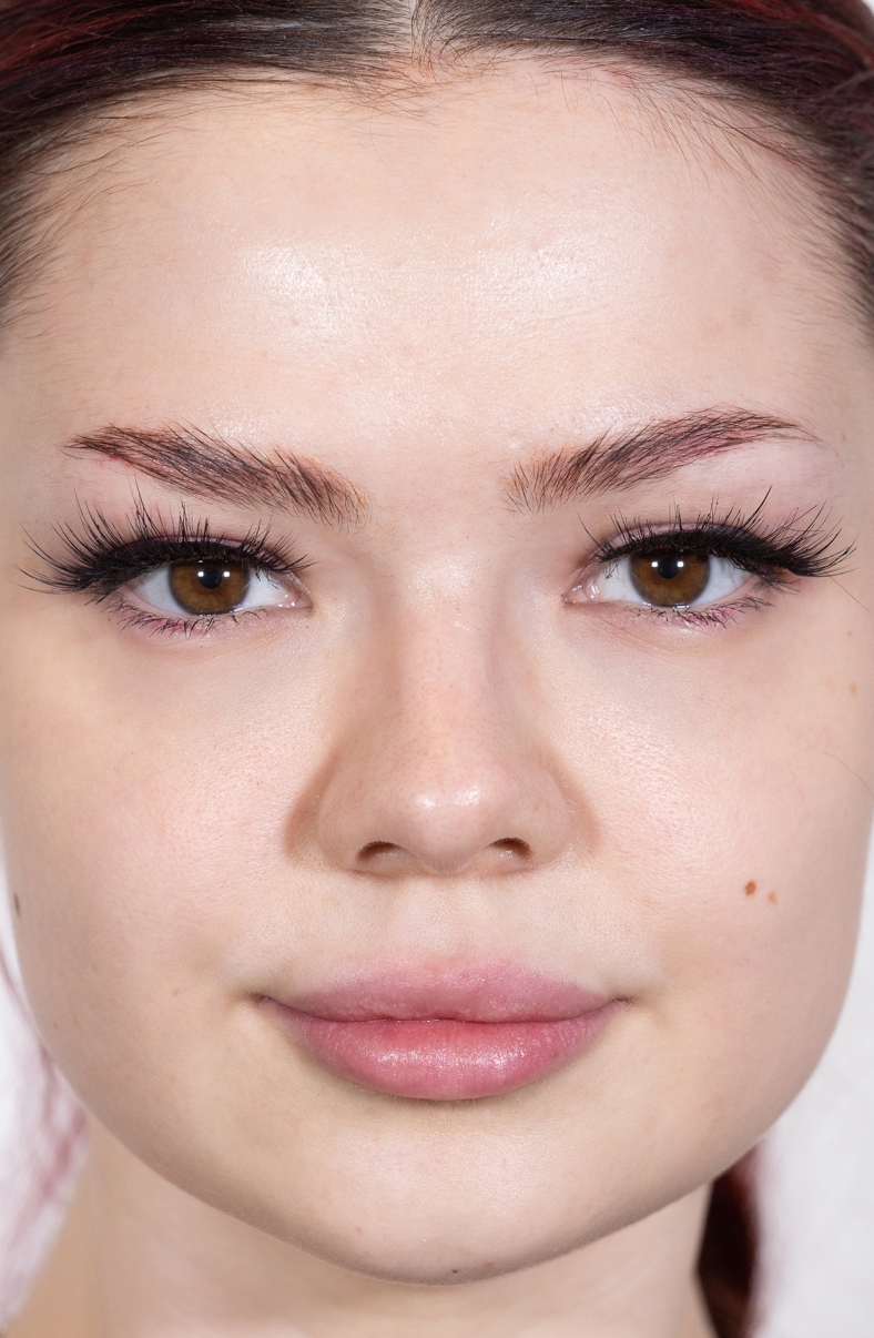 Dermalni fileri, poslije 2022