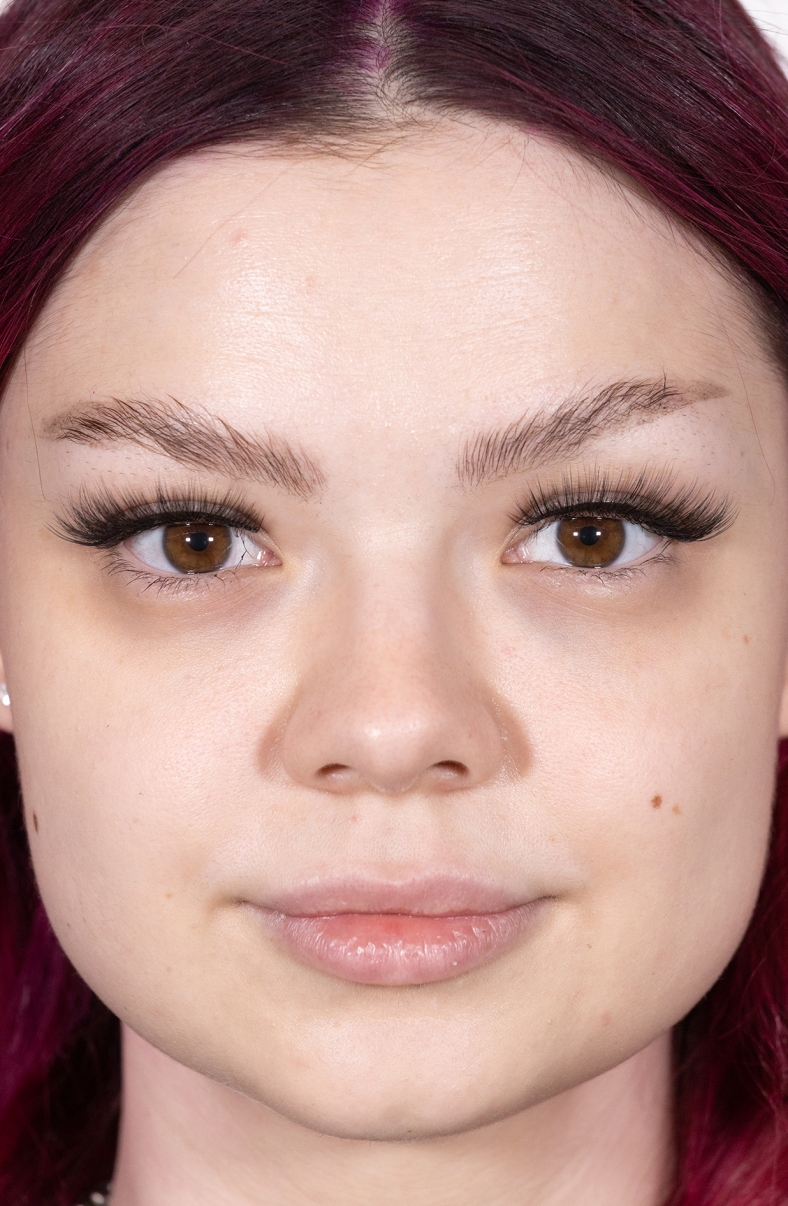 Dermalni fileri, prije 2022