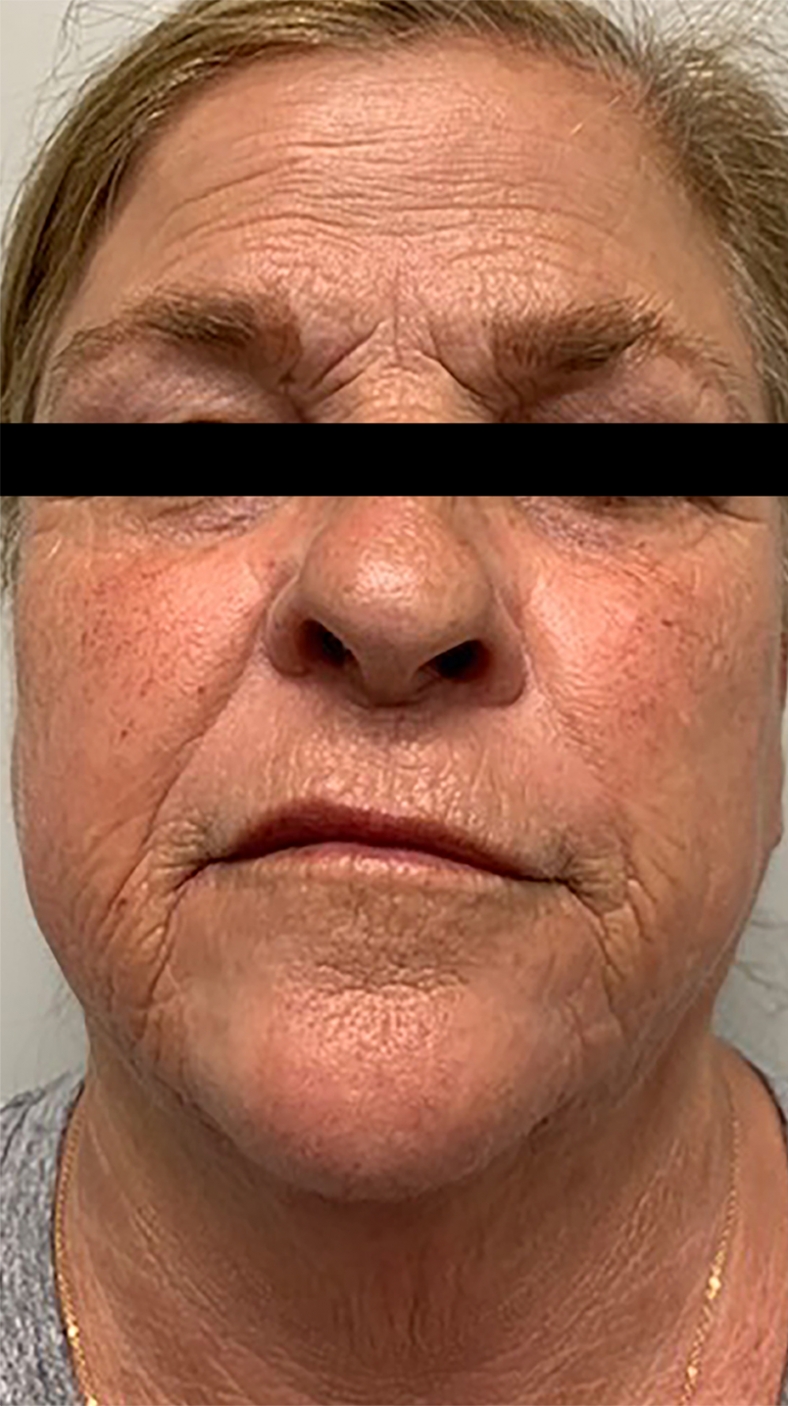 Morpheus8 zatezanje kože - before sl.2