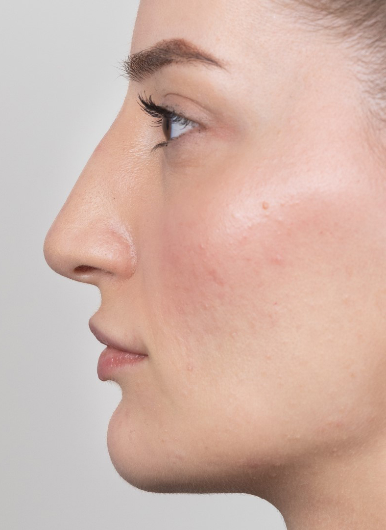 Nekirurška korekcija nosa - poslije, sl. 1 2023