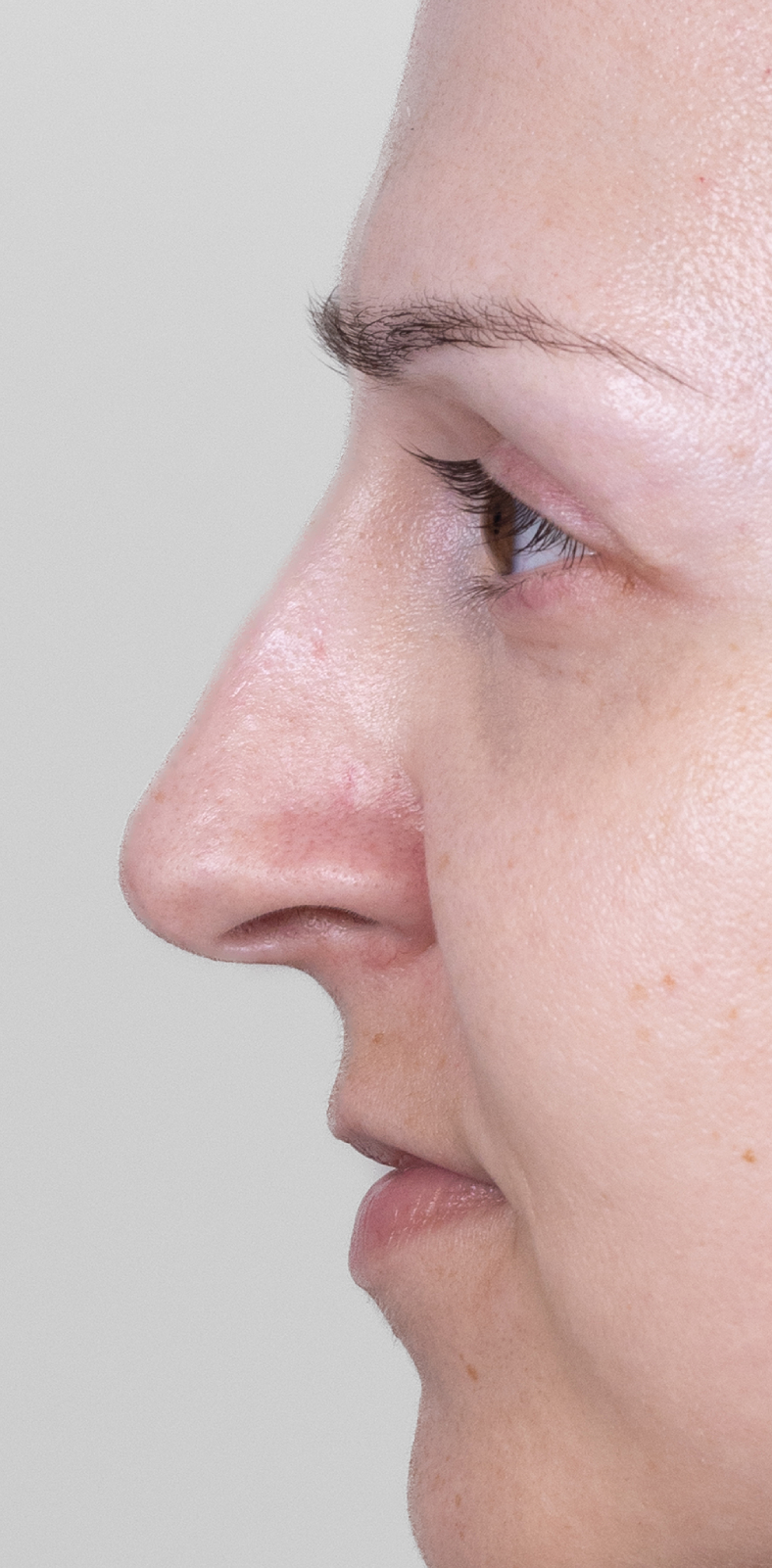 Nekirurška korekcija nosa - poslije, sl. 1 2025