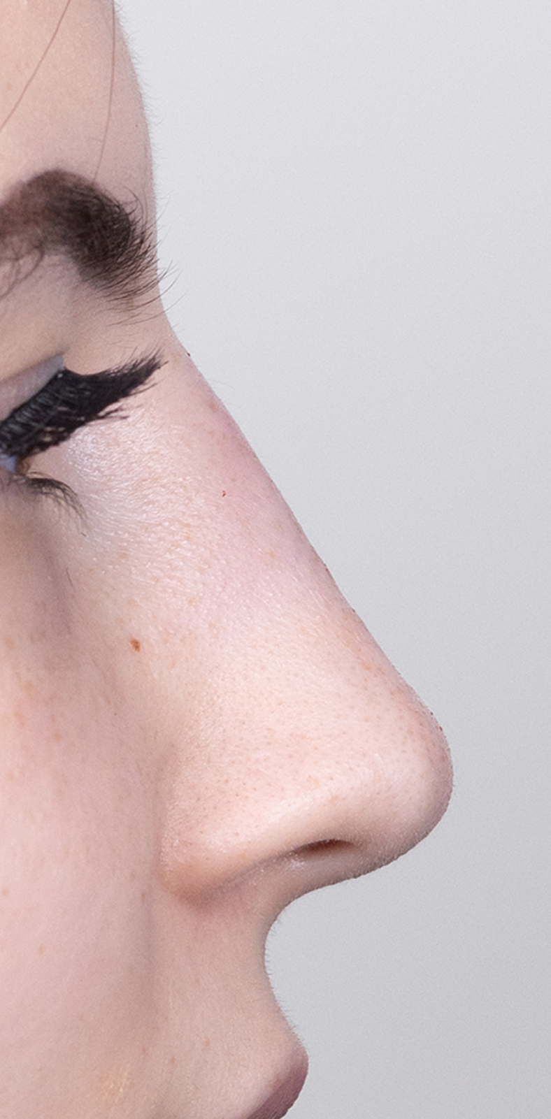Nekirurška korekcija nosa - poslije, sl. 2 2025