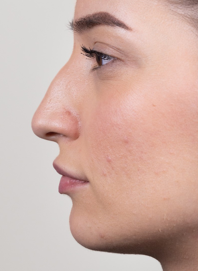 Nekirurška korekcija nosa - prije, sl. 1 2023