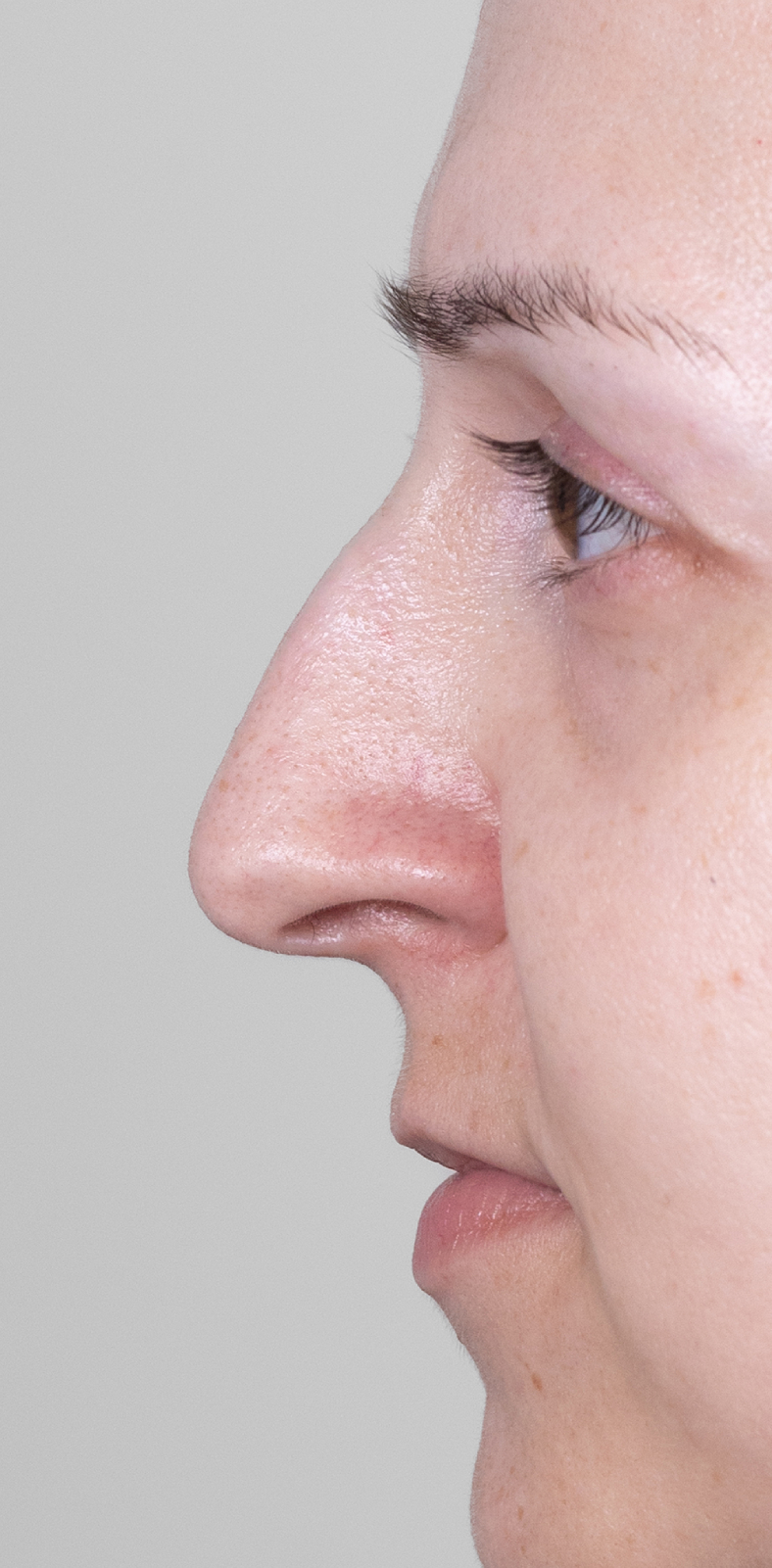 Nekirurška korekcija nosa - prije, sl. 1 2025