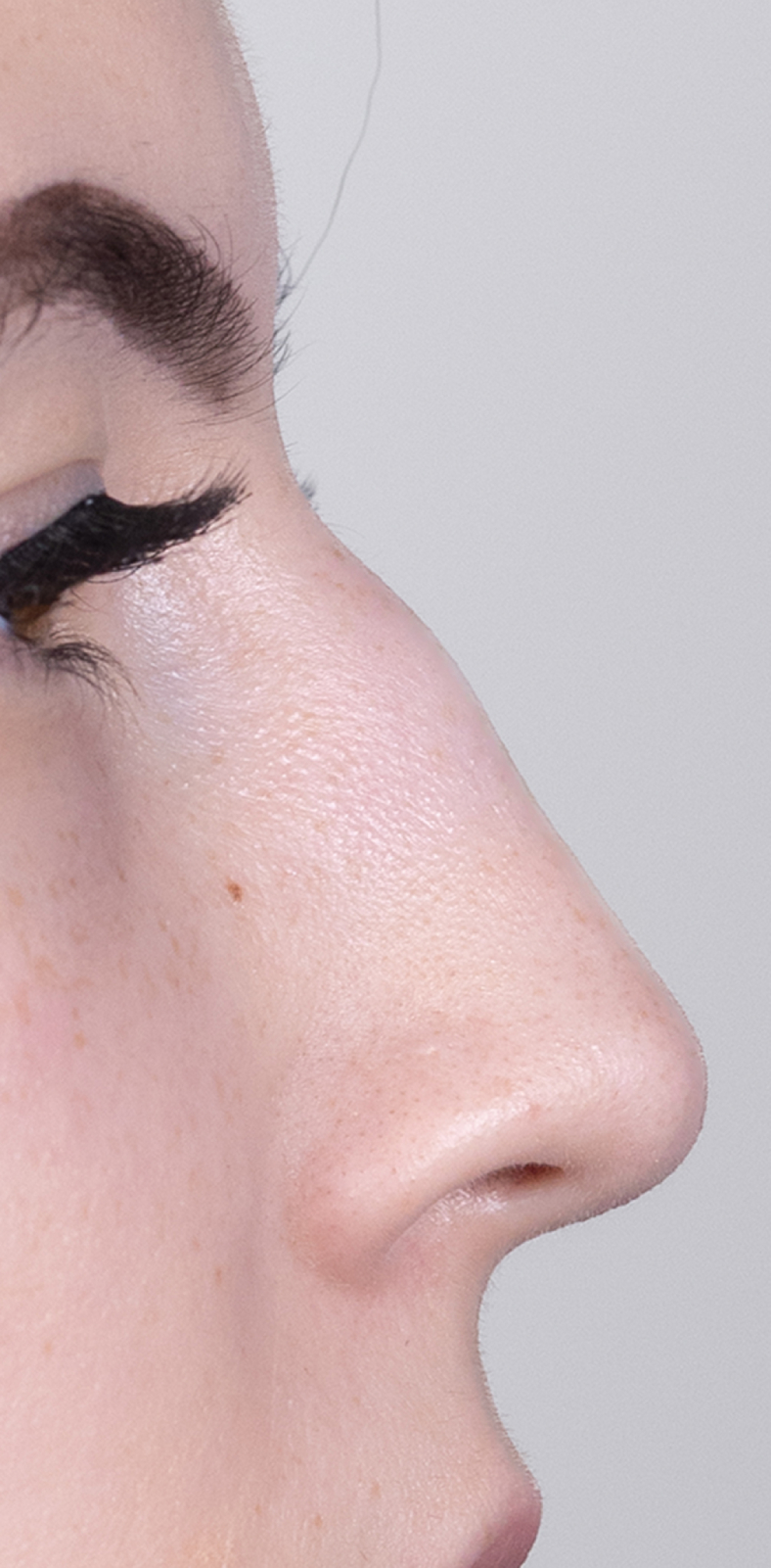 Nekirurška korekcija nosa - prije, sl. 2 2025