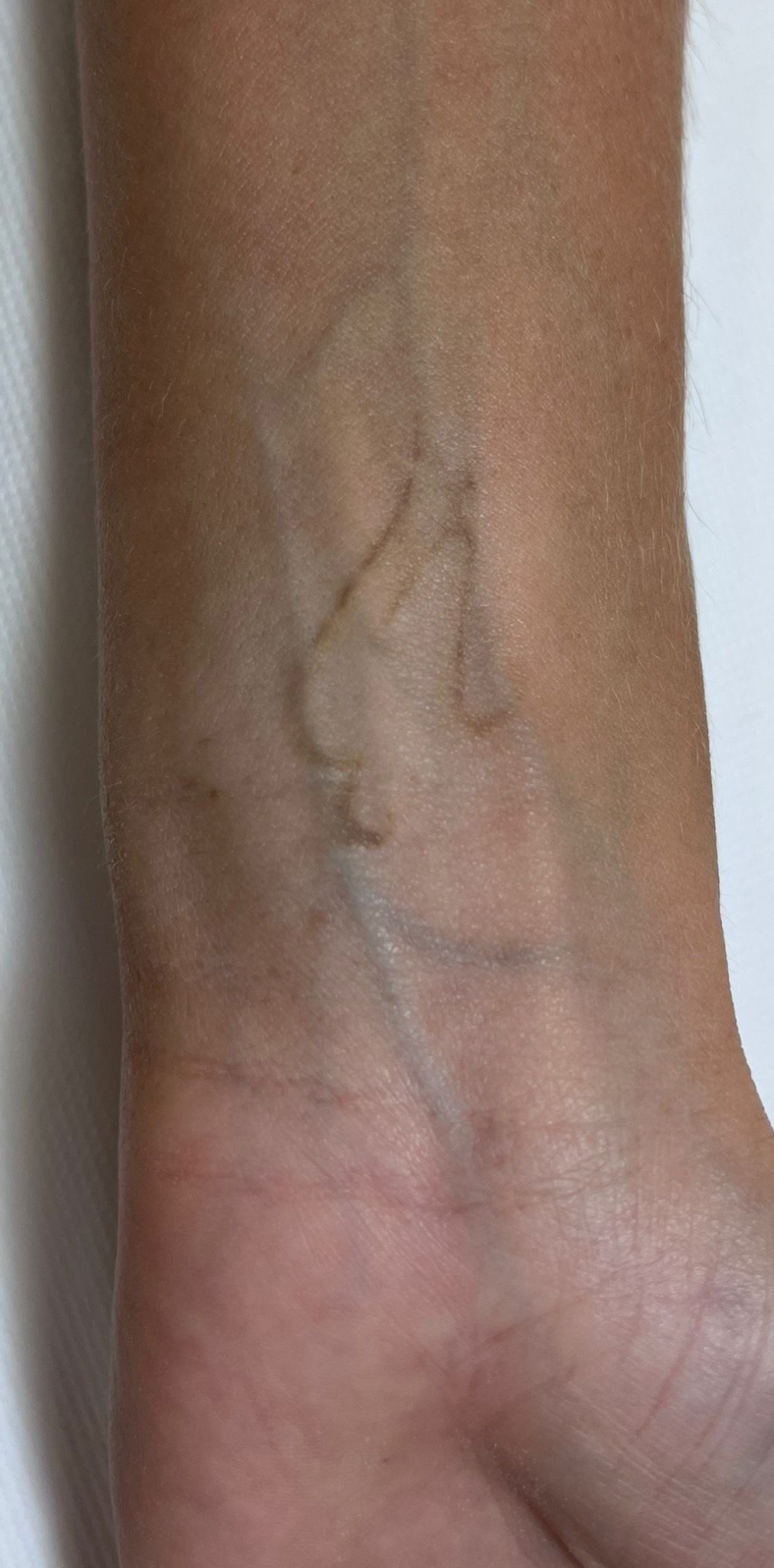 PiQo4 za uklanjanje neželjenih tetovaža, sl. 1 - poslije