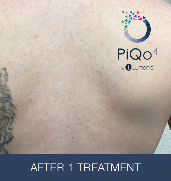 PiQo4 za uklanjanje neželjenih tetovaža, sl. 2 - poslije