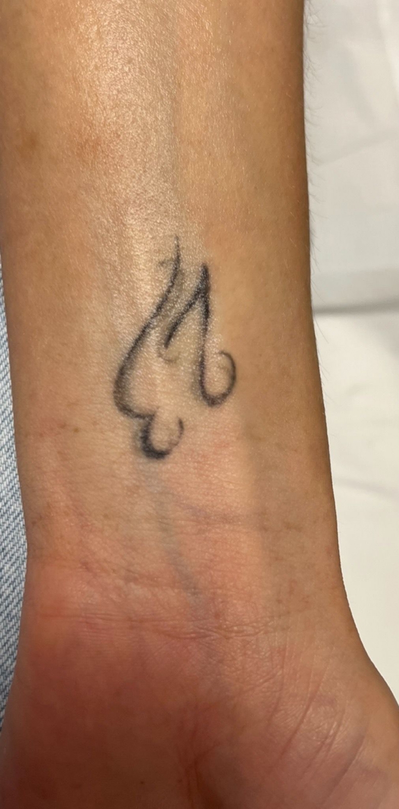 PiQo4 za uklanjanje neželjenih tetovaža, sl. 1 - prije