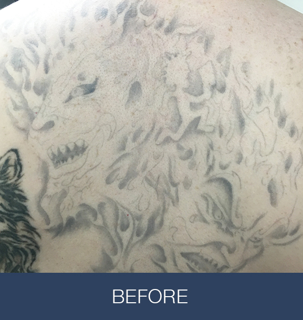 PiQo4 za uklanjanje neželjenih tetovaža, sl. 2 - prije