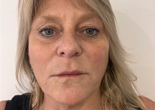 Sunekos biostimulator - Prije sl.1