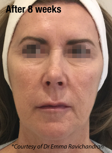 Profhilo poslije, sl. 1