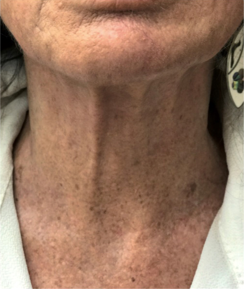 Profhilo poslije, sl. 2