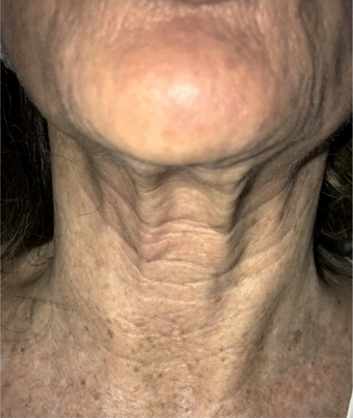 Profhilo prije, sl. 2