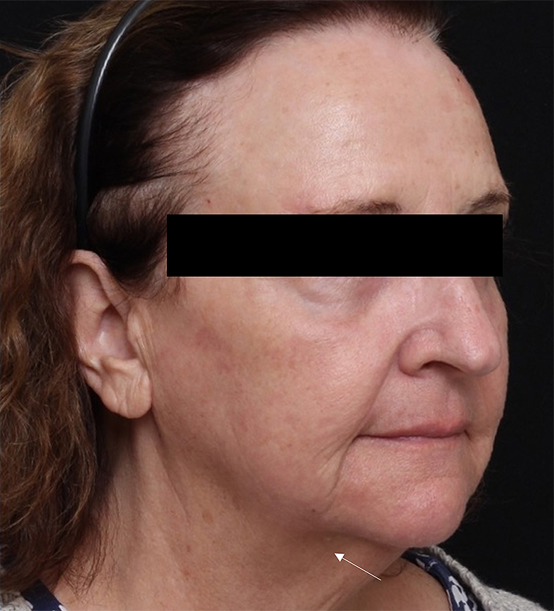 UltraClear frakcijski laser - sl. 1, poslije