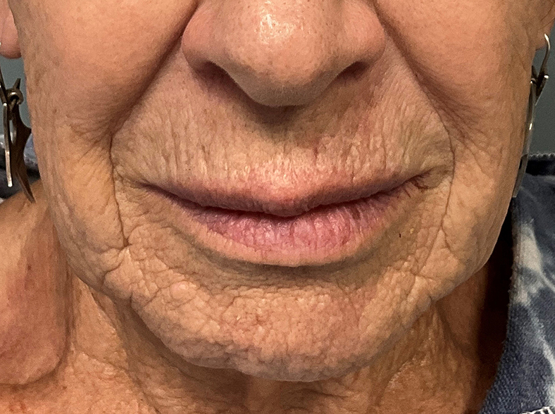 UltraClear frakcijski laser - sl. 2, prije