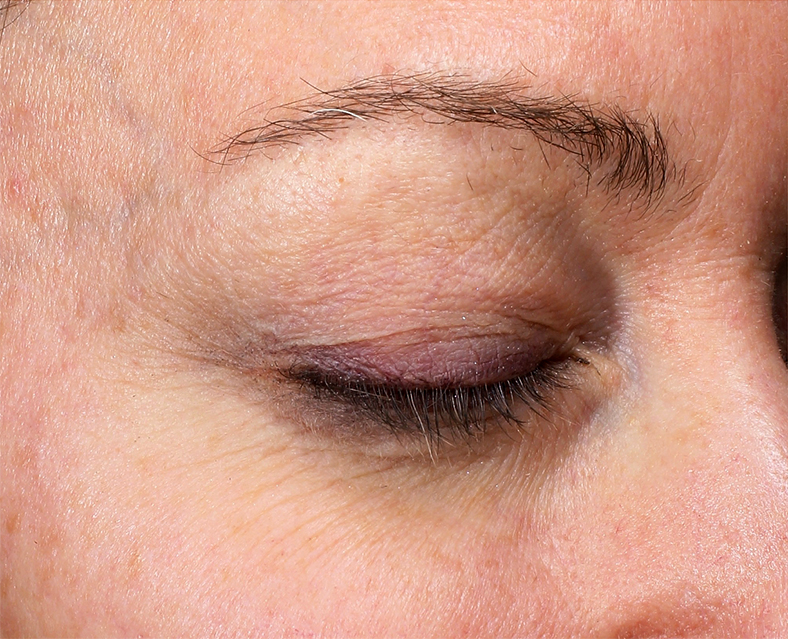 UltraClear frakcijski laser - sl. 3, prije