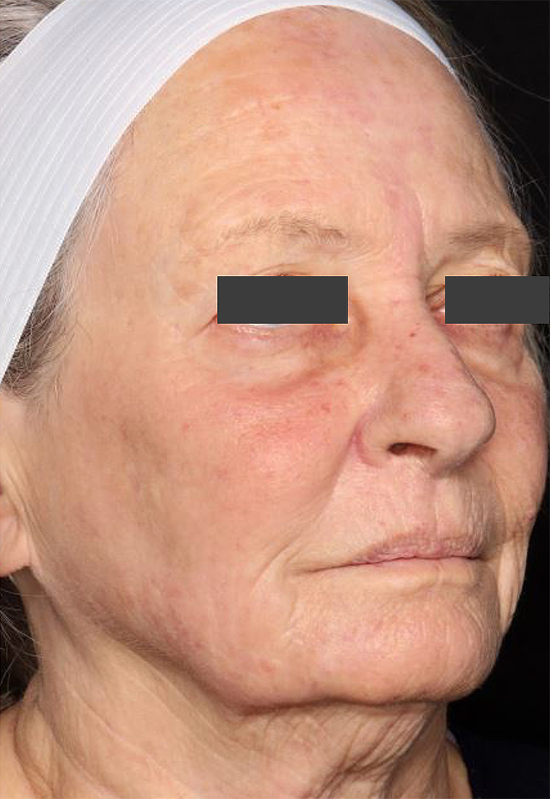 UltraClear frakcijski laser - sl. 4, poslije