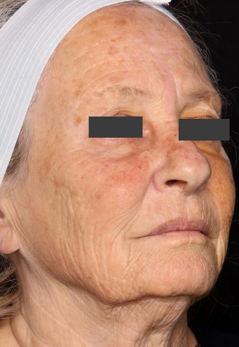 UltraClear frakcijski laser - sl. 4, prije