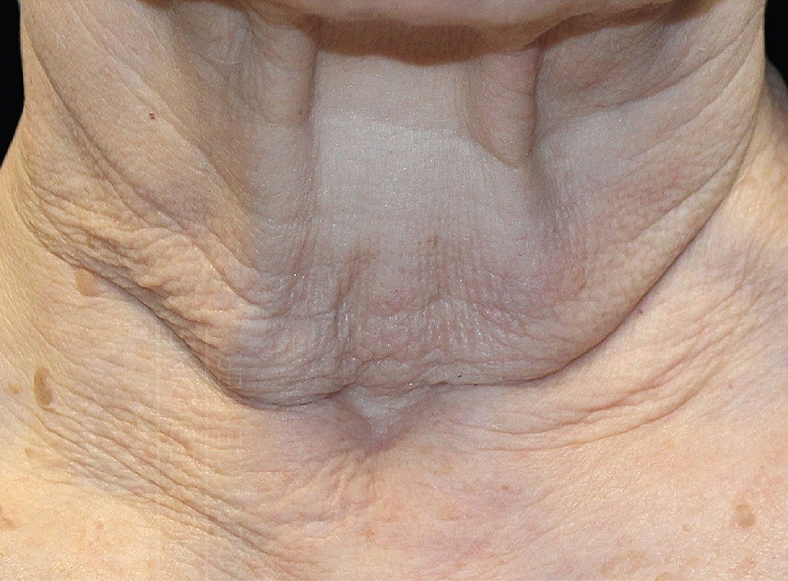 UltraClear frakcijski laser - sl. 5, prije