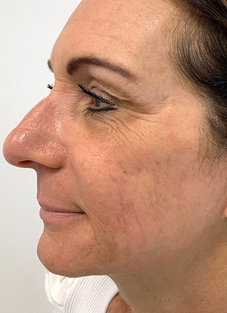 UltraClear frakcijski laser - sl. 7, poslije