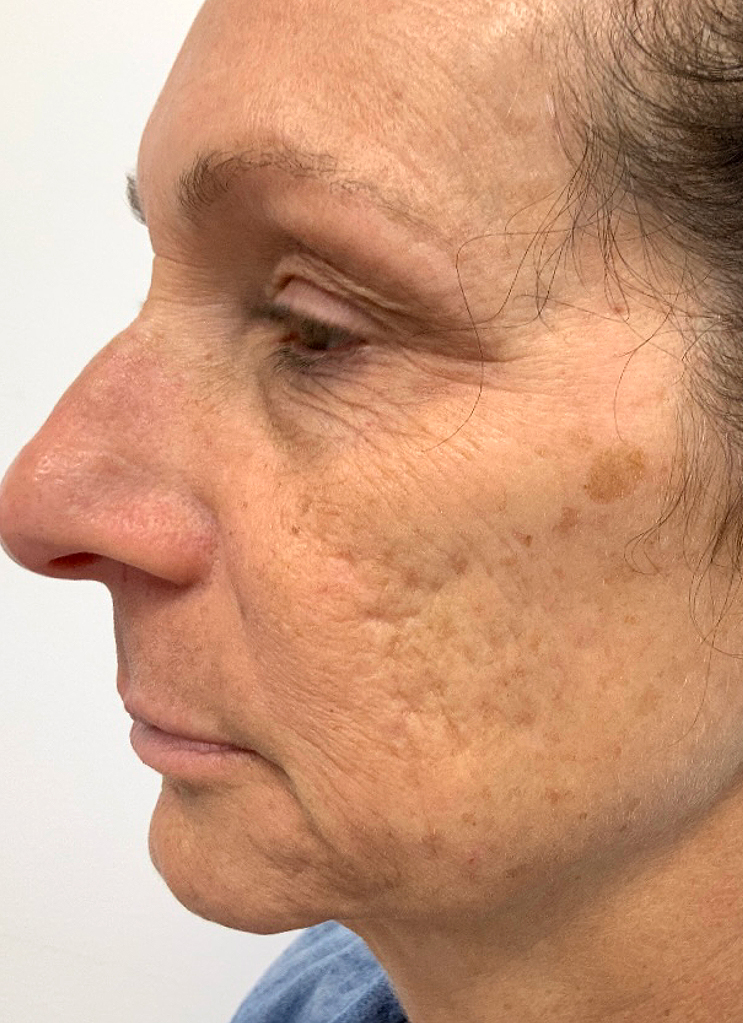 UltraClear frakcijski laser - sl. 7, prije