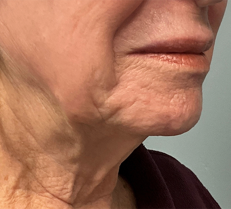 UltraClear frakcijski laser - sl. 6, poslije